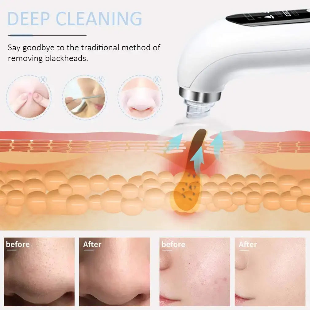 Dissolvant d'aspiration sous vide Blackhead