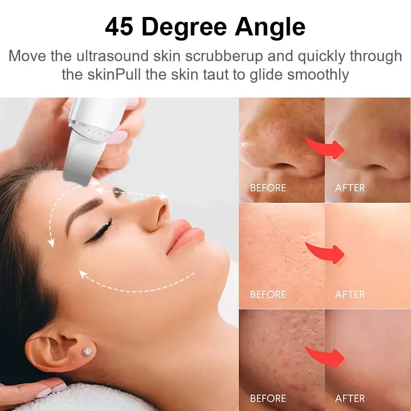 Nettoyant pour les points noirs pour le gommage de la peau